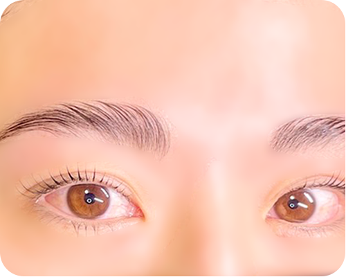 ハリウッドブロウリフトの施術前後写真