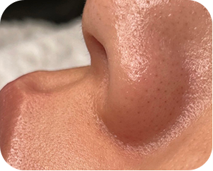 ハリウッドブロウリフトの施術前後写真