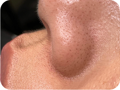 ハリウッドブロウリフトの施術前写真